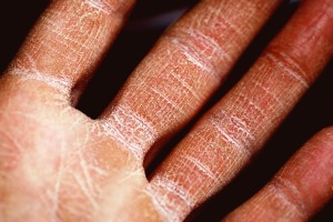 What Is Eczema? 1