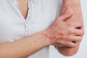 What Is Psoriasis? 2